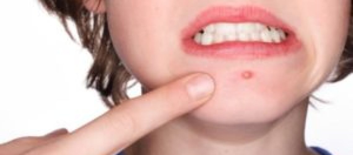 what can cause acne