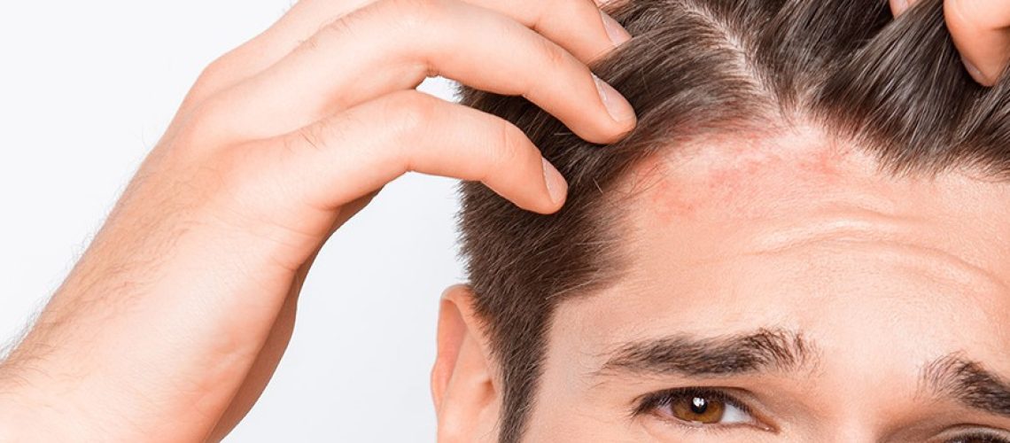 Dermatite-Seborreica-causas