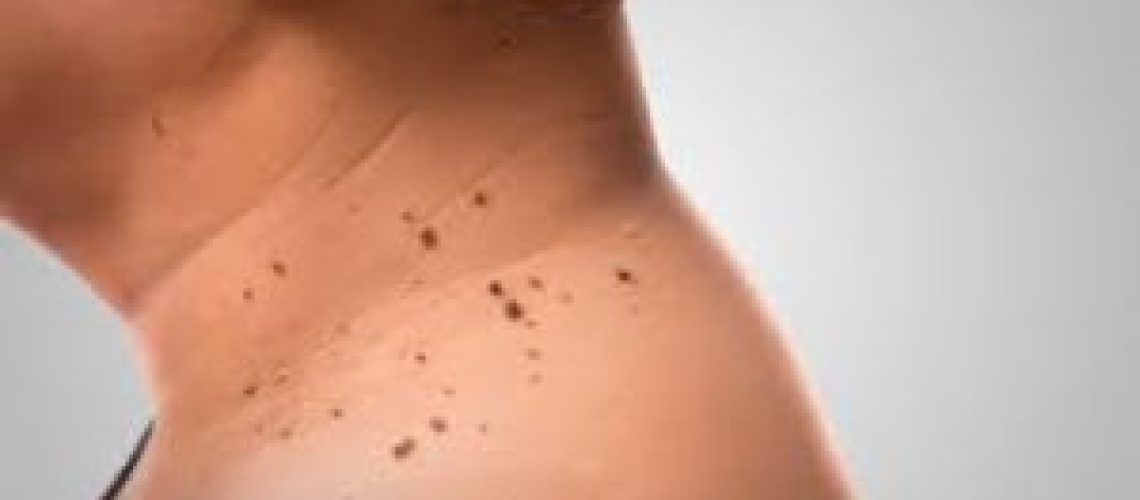 acrocórdons-300x150