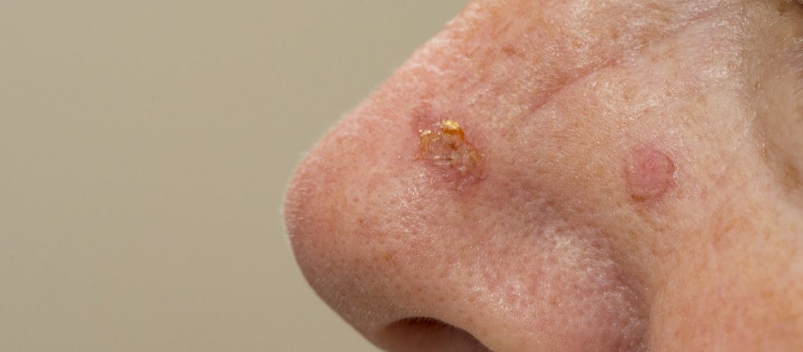 cancer-de-pele-1216-1400x800_2