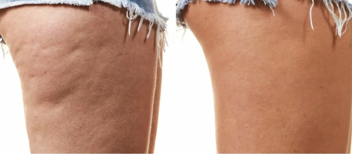 cellulite