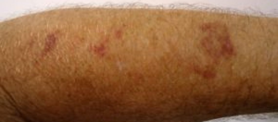 confira-agora-as-10-doencas-que-podem-causar-mancha-vermelha-na-pele-3-300x190