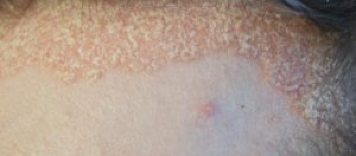 paciente-com-psoriase-300x199