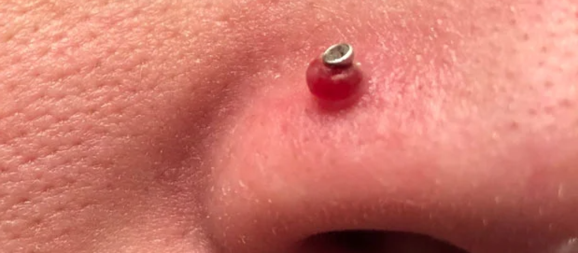 queloide-no-nariz-com-piercing-jpg-626×416-