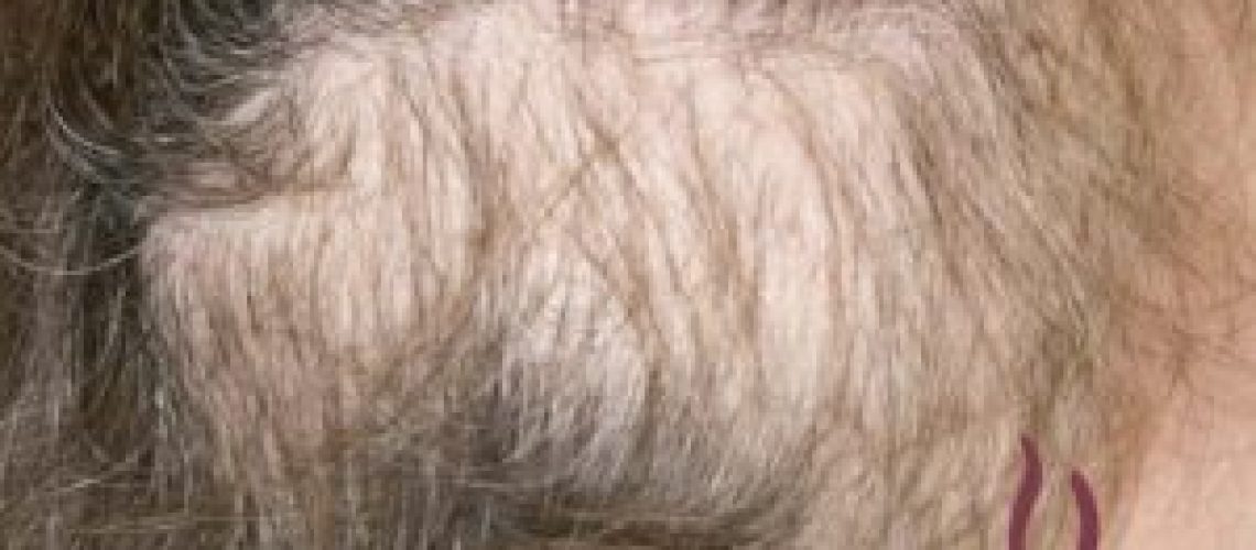 tricotilomania-300x214