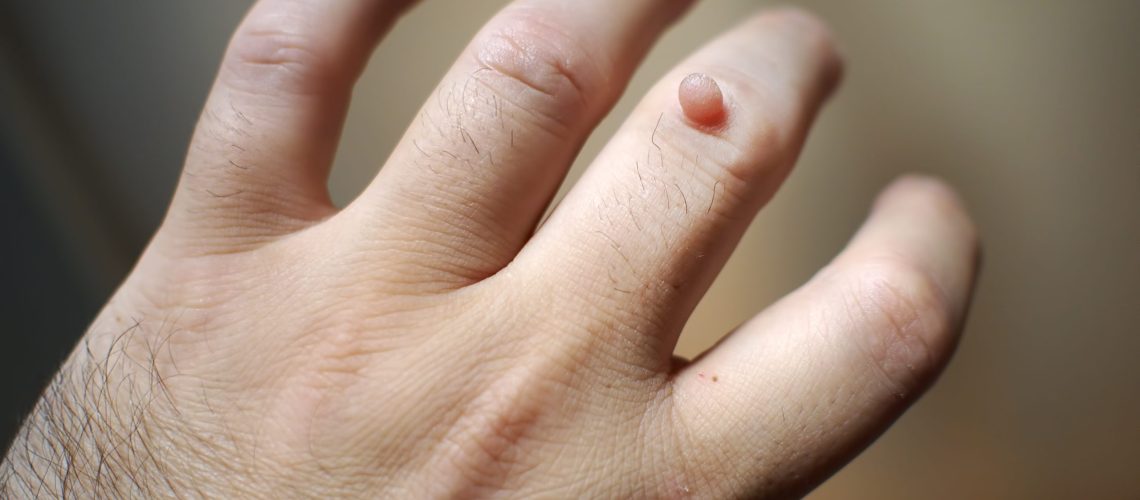 verruga nas mãos